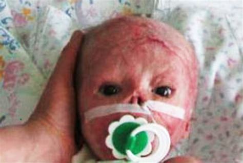 Baby suffered painful burns after blaze caused by dads exploding。